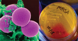 甲氧西林耐金黄色葡萄球菌（MRSA）