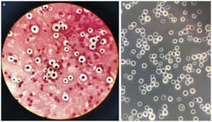 革兰氏染色(图A)和印墨染色(图B)显示有大量囊状圆形酵母，并有一些萌芽形式。