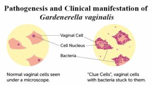 阴道栀子菌的发病机制及临床表现