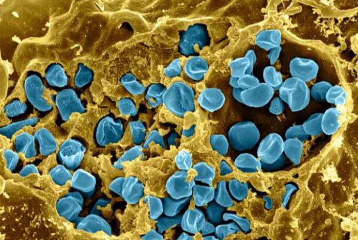 Pathogenesis and Clinical manifestations of Francisella tularensis