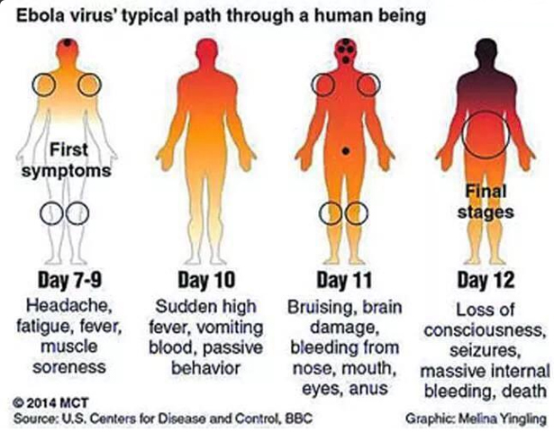 埃博拉病毒的临床表现