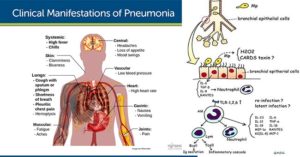 肺炎支原体的发病机制和临床表现