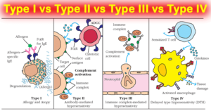 I型，II型，III型和IV型过敏症在一张表中