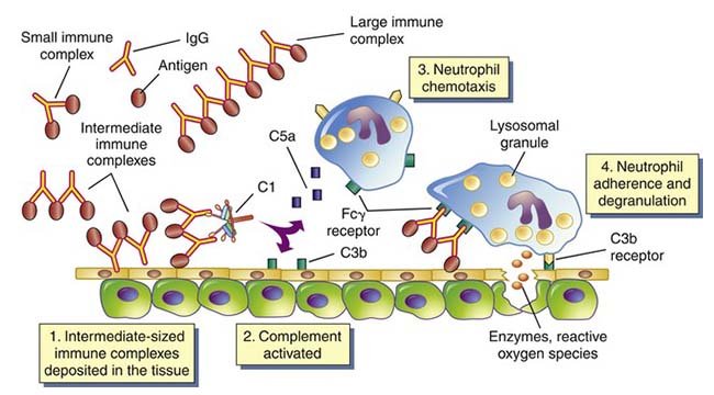 III型（免疫复合物）超敏反应机制和实例