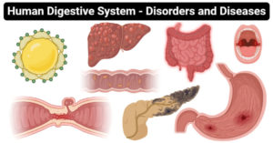 人体消化系统的疾病和疾病
