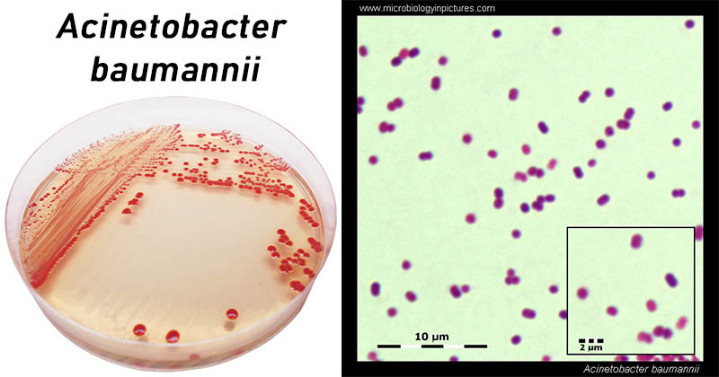 AcineTobacter Baumannii-实验室诊断，治疗和预防