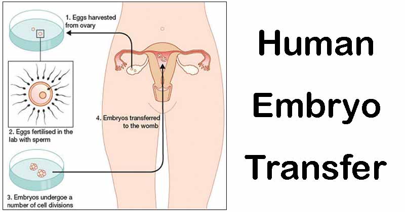 人类胚胎转移