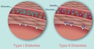 1型糖尿病和2型糖尿病