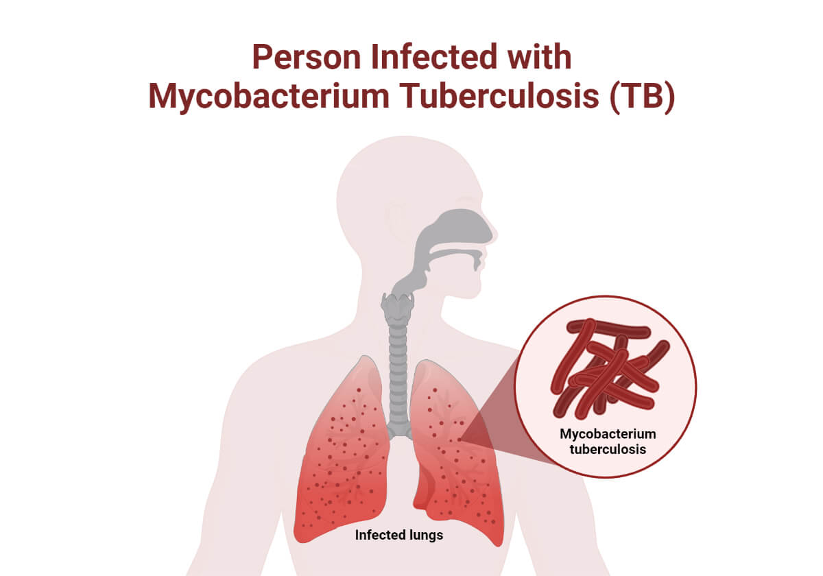 结核分枝杆菌感染者(TB)